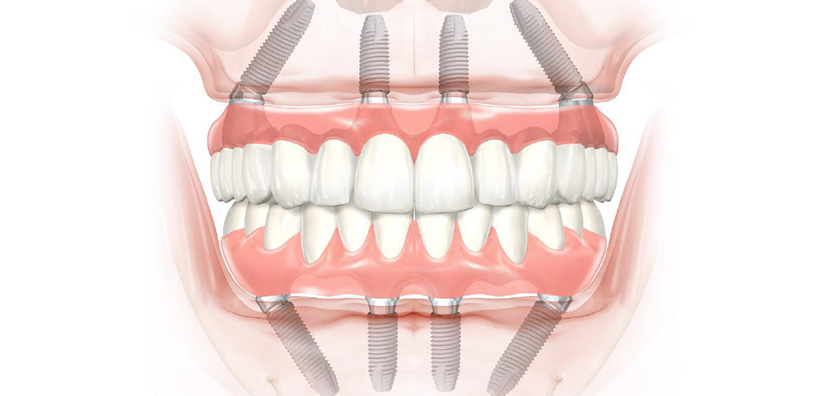 Photo d'un d'un dentiste réalisant une chirurgie buccodentaires sur un patient